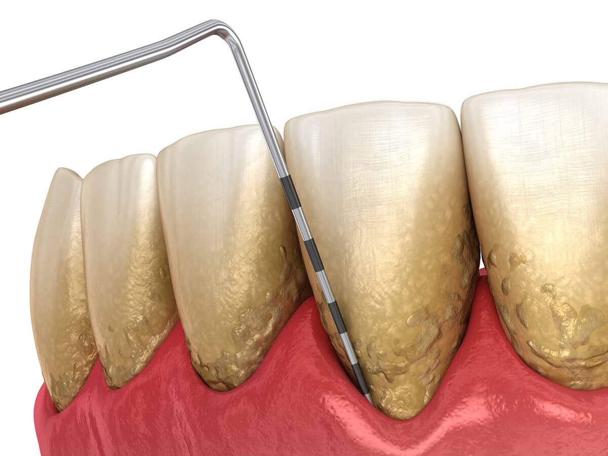 Gum Disease Treatment