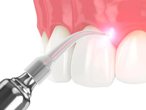 Soft Tissue Laser in Tucson and Chandler, AZ at Artistic Dentistry Arizona