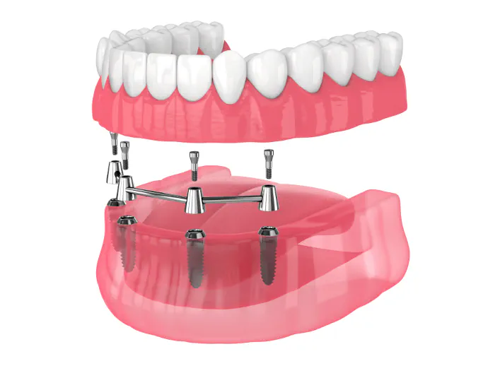 Full-Mouth Rehabilitation